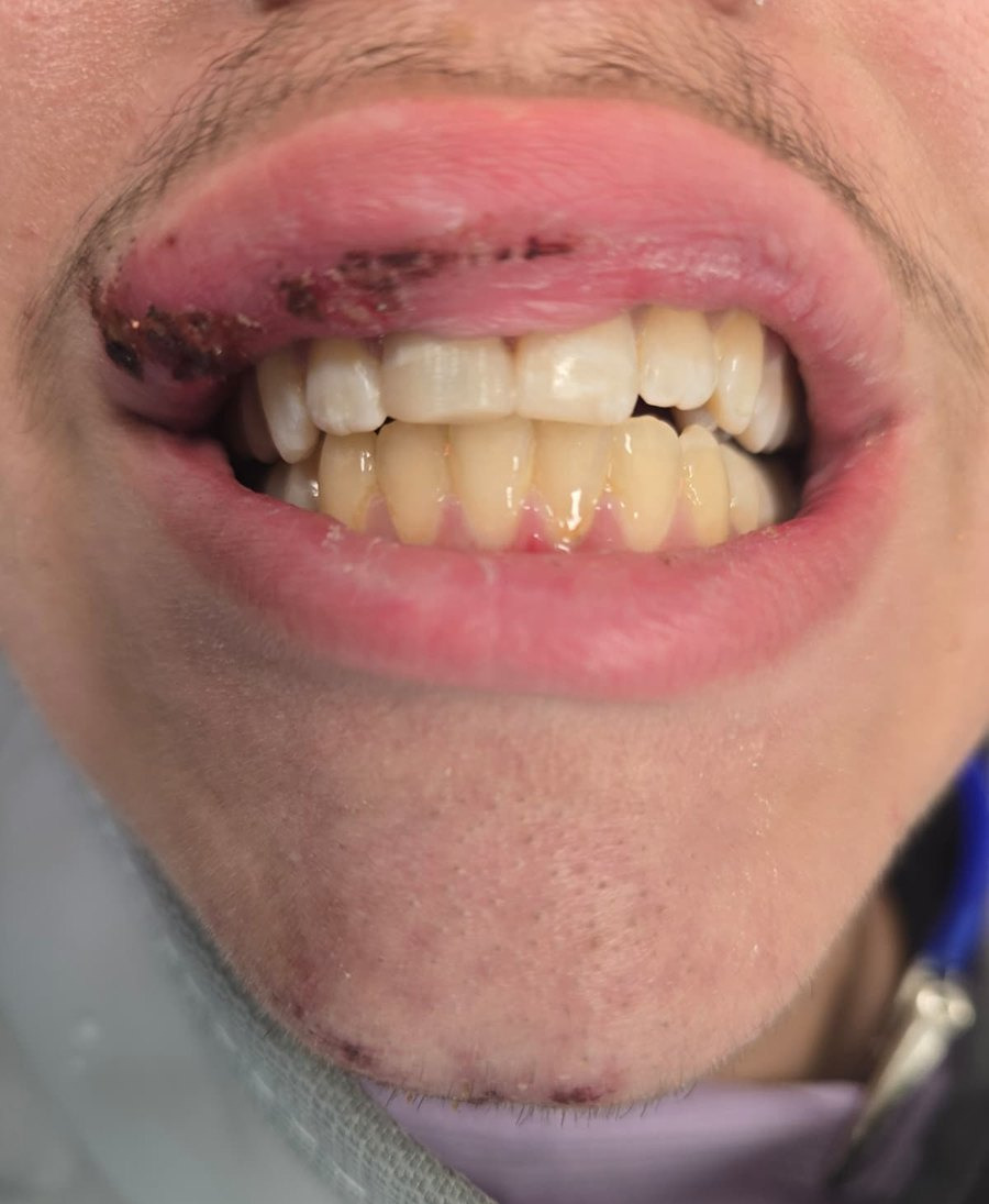 After — Broken front teeth repaired after an accident at Smile Makers of Georgia in Alpharetta
