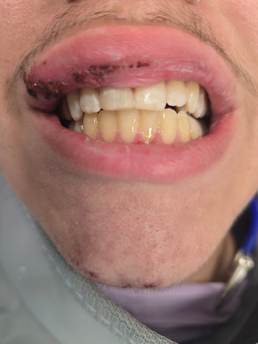 After — Broken front teeth repaired after an accident at Smile Makers of Georgia in Alpharetta