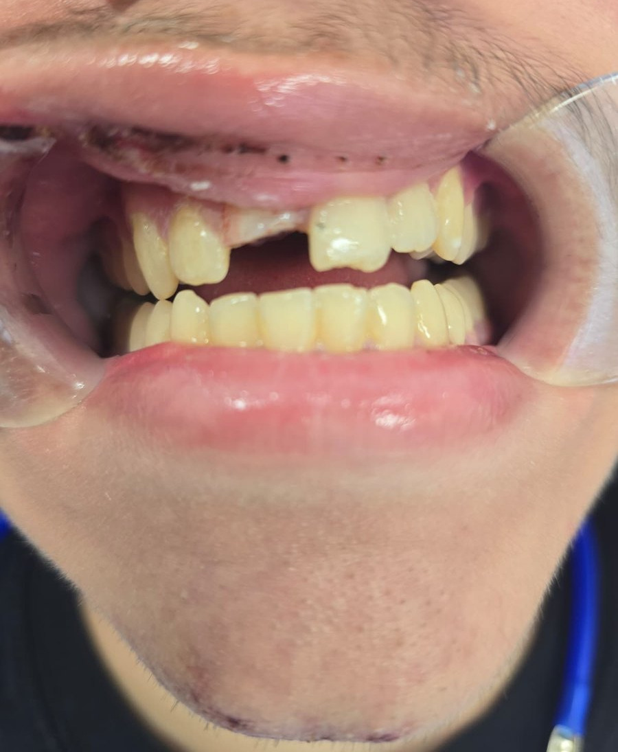 Before — Broken front teeth repaired after an accident at Smile Makers of Georgia in Alpharetta