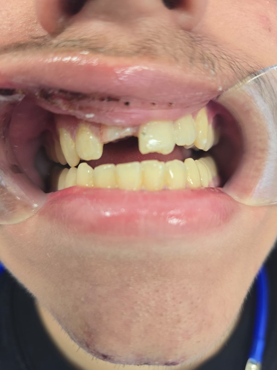 Before — Broken front teeth repaired after an accident at Smile Makers of Georgia in Alpharetta