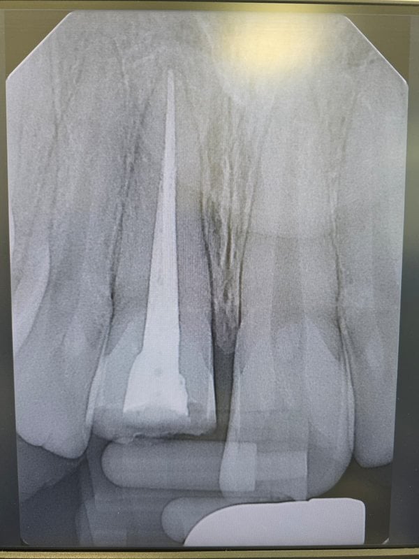 X-ray of the completed restoration — Rebuilt After an Accident