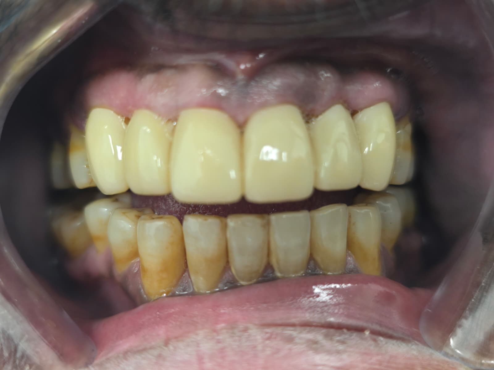 After — Upper front teeth restored with new crowns at Smile Makers of Georgia in Alpharetta