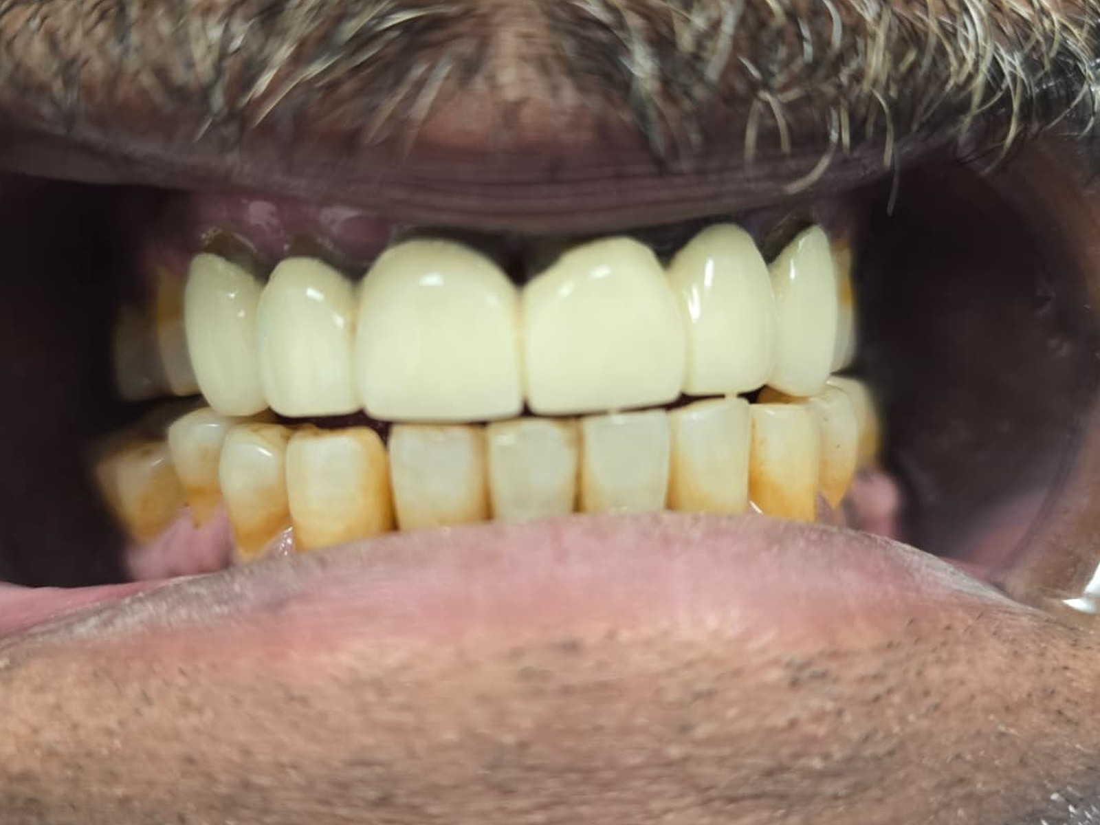 Before — Upper front teeth restored with new crowns at Smile Makers of Georgia in Alpharetta
