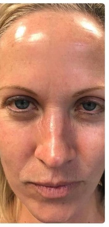 After — BOTOX forehead lines before and after at Smile Makers of Georgia in Alpharetta