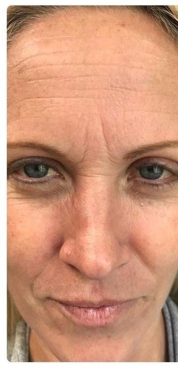 Before — BOTOX forehead lines before and after at Smile Makers of Georgia in Alpharetta