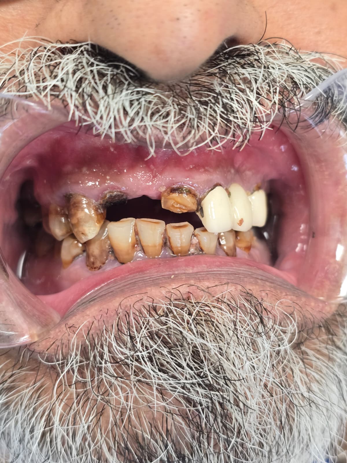 The damage before treatment, close up — Broken Front Teeth, Smile Restored