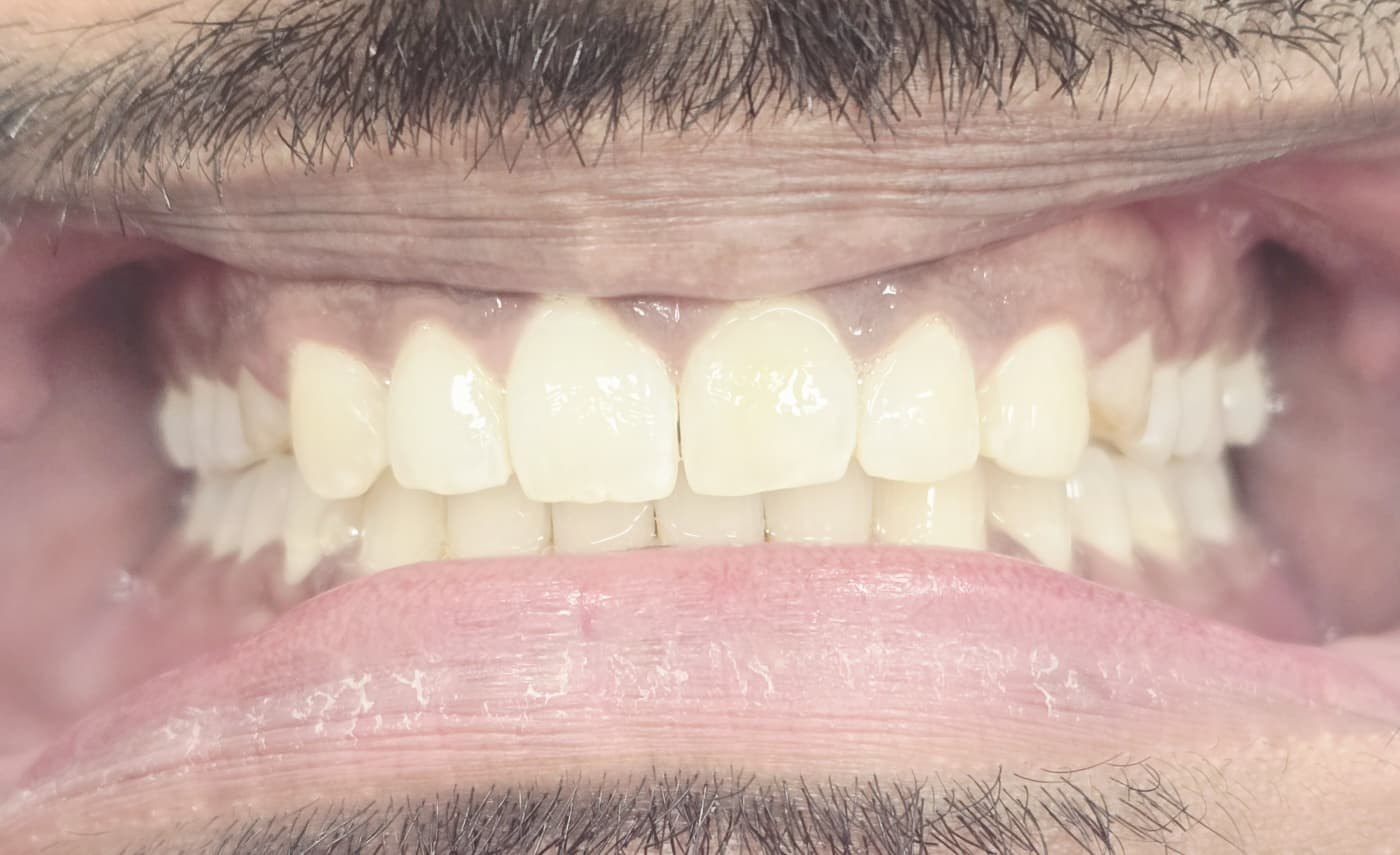 After — Clear aligner treatment before and after — midline gap closed and bite corrected at Smile Makers of Georgia in Alpharetta