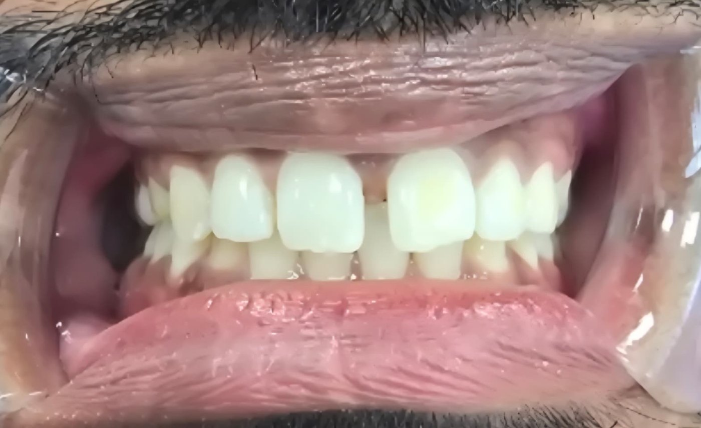 Before — Clear aligner treatment before and after — midline gap closed and bite corrected at Smile Makers of Georgia in Alpharetta