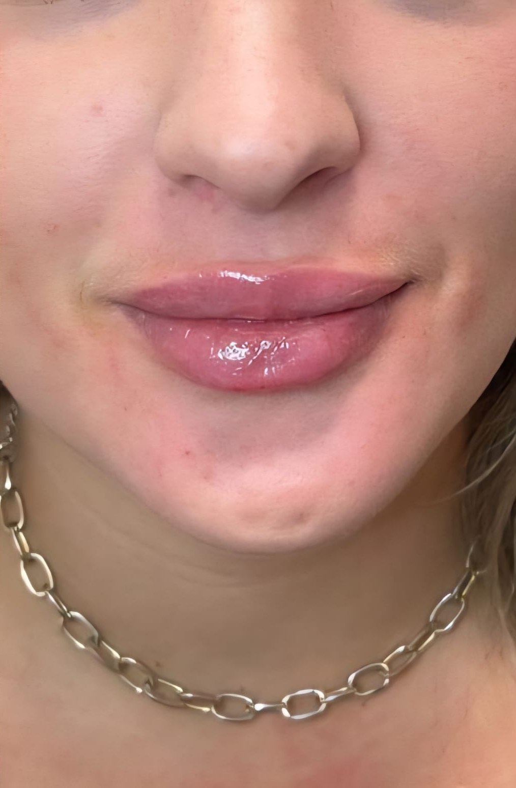 After — Lip enhancement before and after at Smile Makers of Georgia in Alpharetta