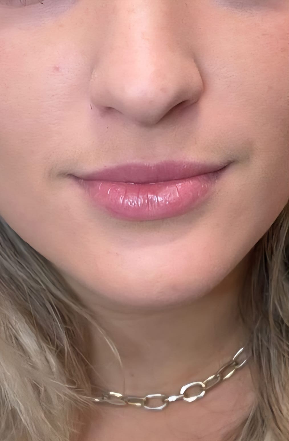 Before — Lip enhancement before and after at Smile Makers of Georgia in Alpharetta