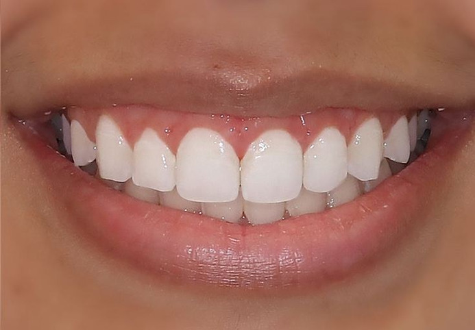 After — Gum contouring before and after at Smile Makers of Georgia in Alpharetta