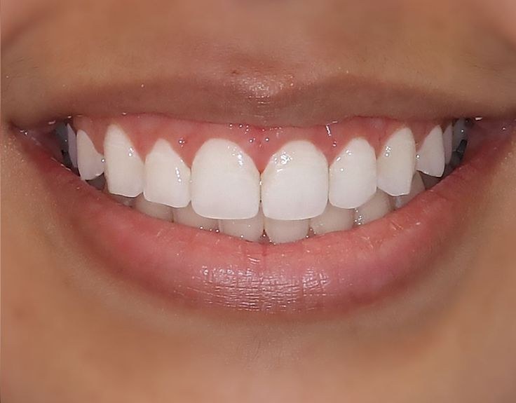 After — Gum contouring before and after at Smile Makers of Georgia in Alpharetta