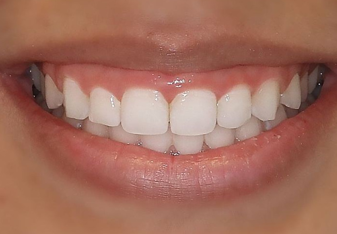 Before — Gum contouring before and after at Smile Makers of Georgia in Alpharetta