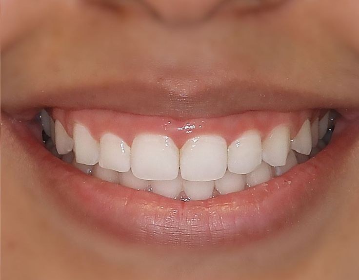 Before — Gum contouring before and after at Smile Makers of Georgia in Alpharetta