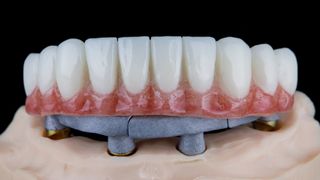 A fixed dental prosthesis anchored to four implant abutments in a lab model, the same geometry an implant-supported fixed arch uses in the mouth.