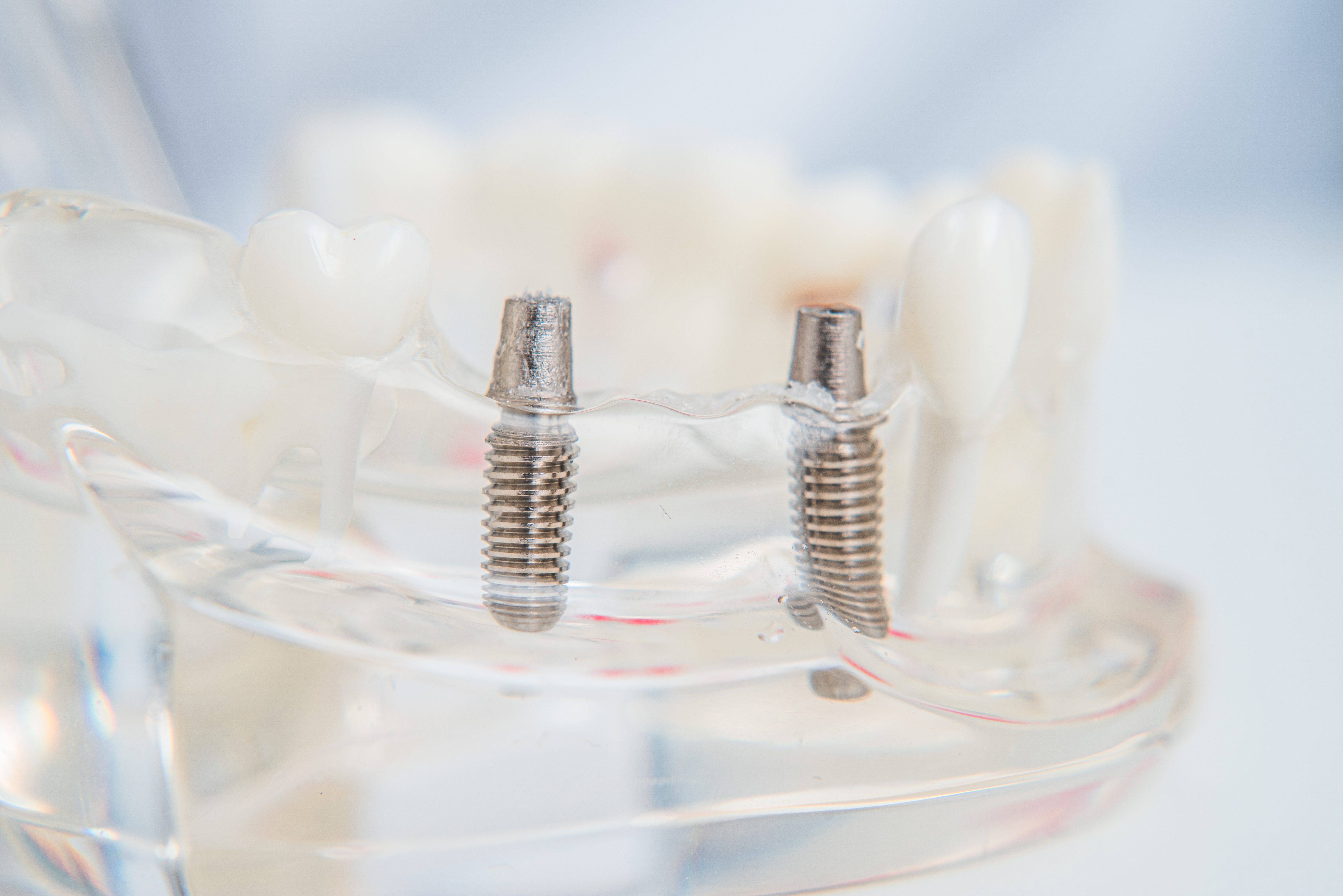 Dental Implants