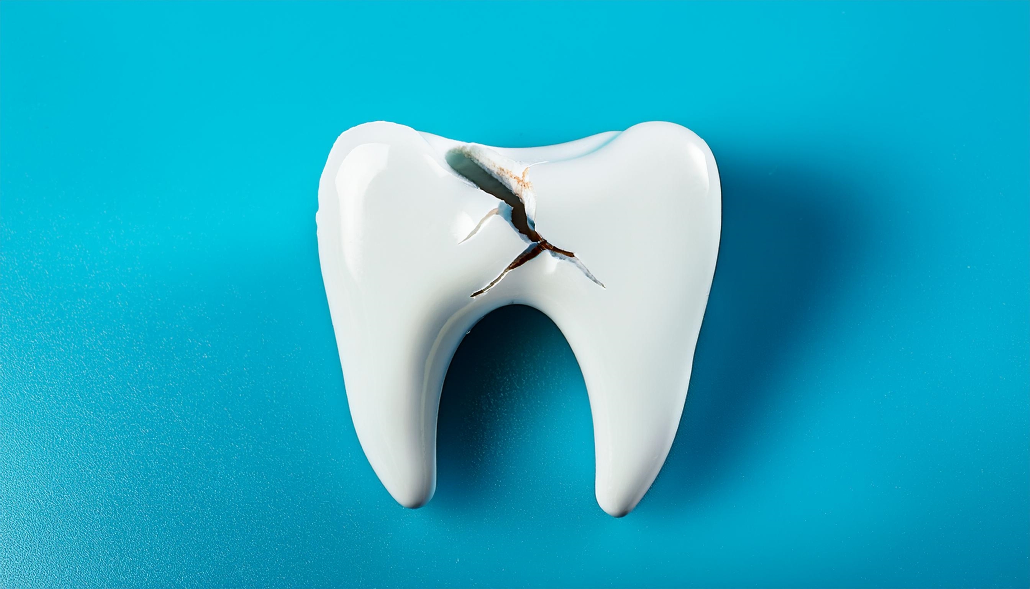Model of a cracked molar