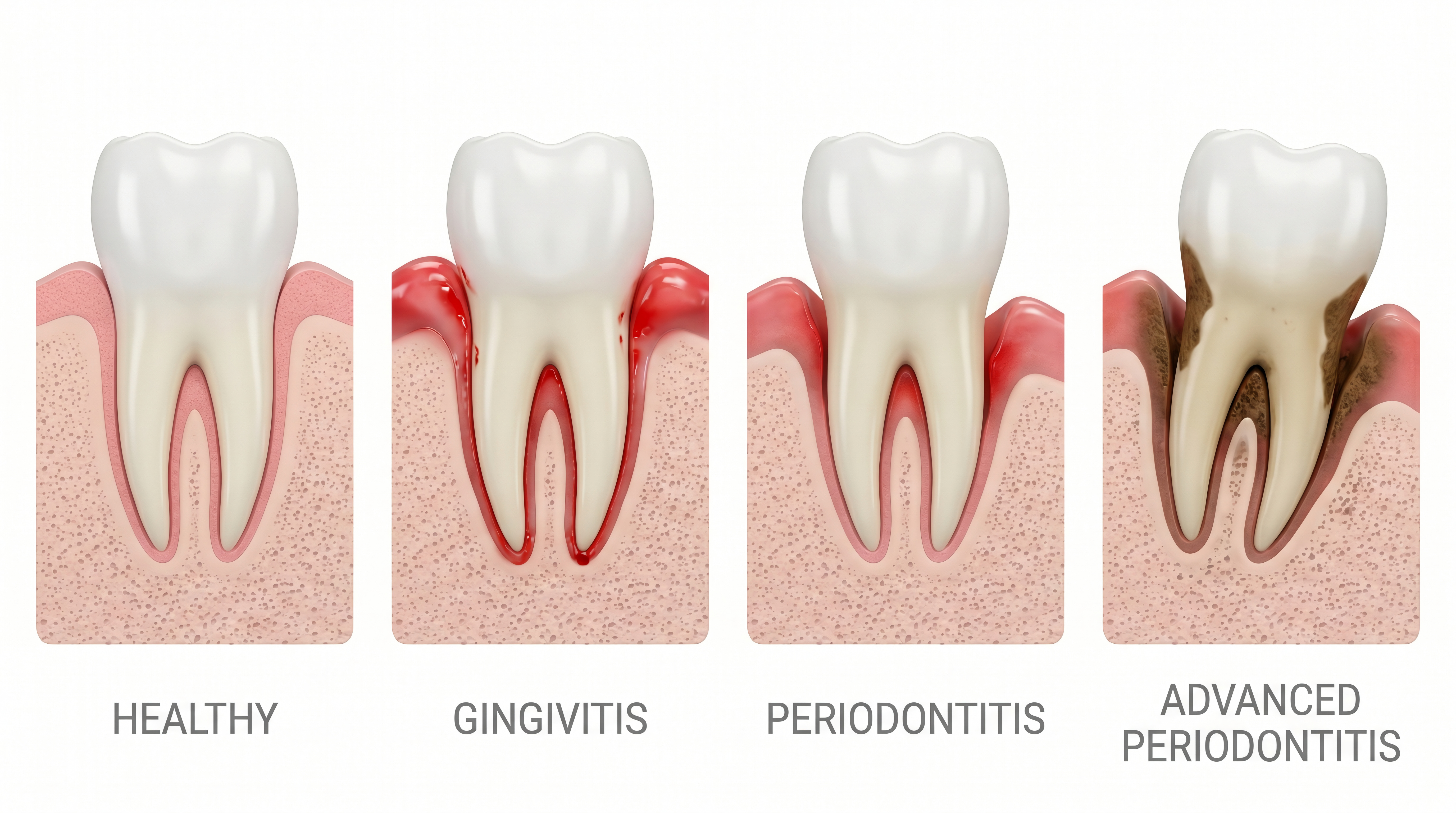 Illustration of gum disease stages
