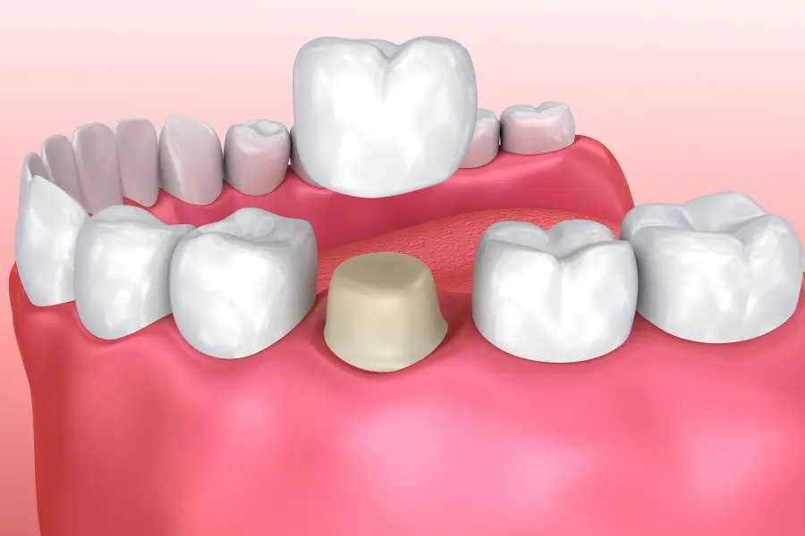 Illustration of a crown over a prepared tooth