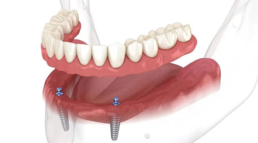 Illustration of a full arch of teeth on implants