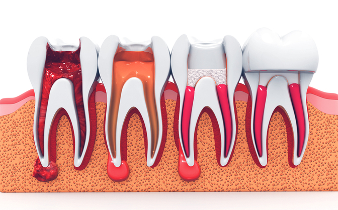 Illustration of a tooth in cross-section from healthy to infected pulp