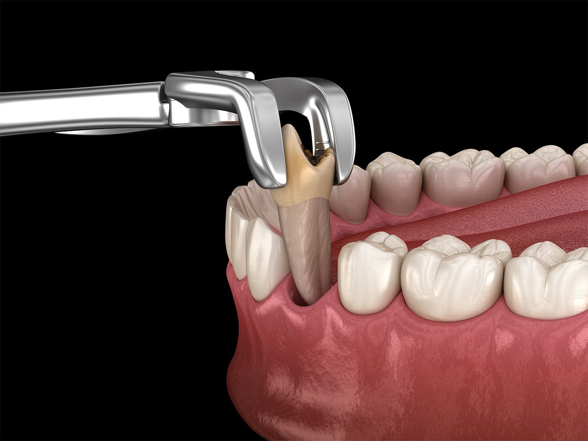 Illustration of a molar being removed