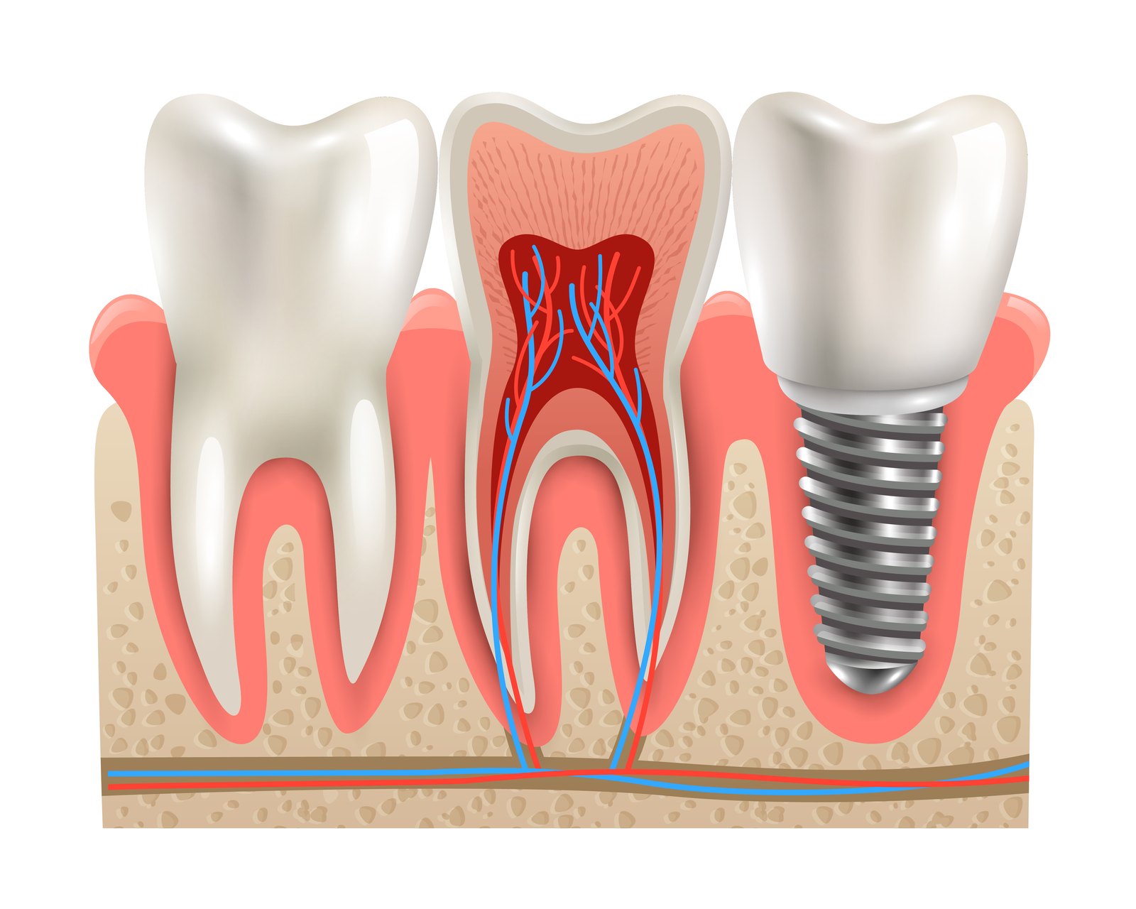 Illustration comparing a natural tooth, a treated tooth and an implant